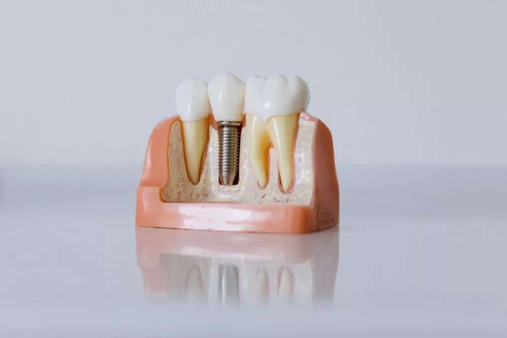 Understanding Nuvia Dental Implant Costs: A Detailed Look at Your Investment